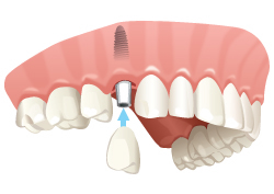 Dentalimplant5